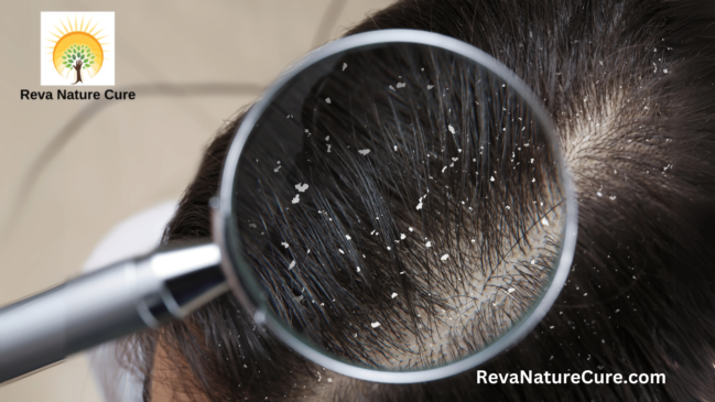 Effective Home Remedies for Dandruff Treatment