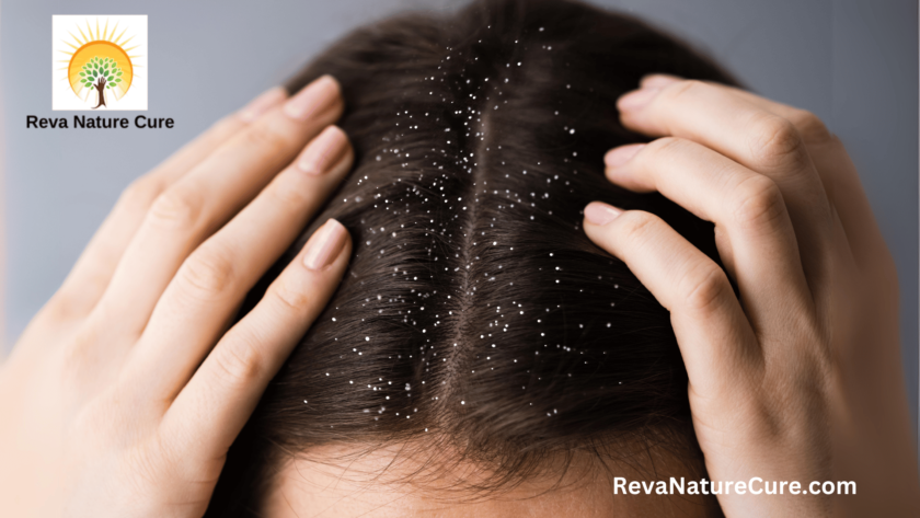 Dandruff and Its Causes